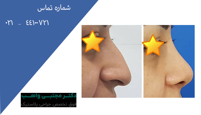 جراحی بینی برای چه افرادی منع شده است؟