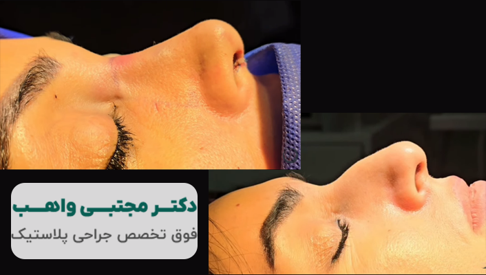 جراحی بینی دکتر واهب