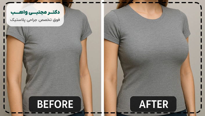 پروتز سينه سايز ٨٥