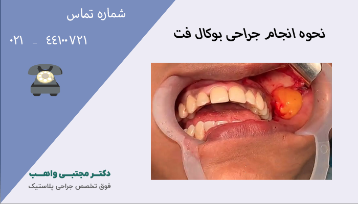 نحوه انجام بوکال فت