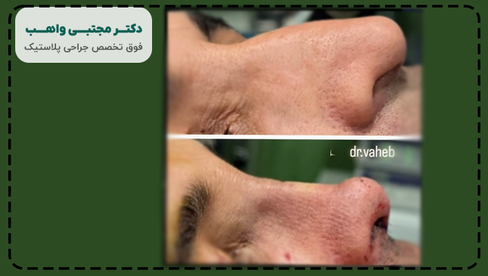 نمونه کار جراحی بینی دکتر واهب