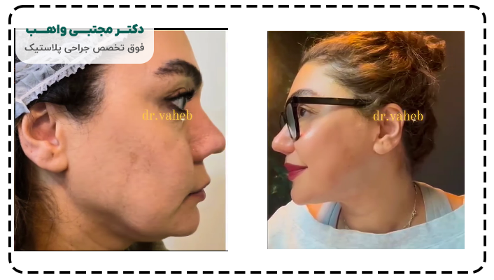 نمونه کار لیفت صورت دکتر مجتبی واهب