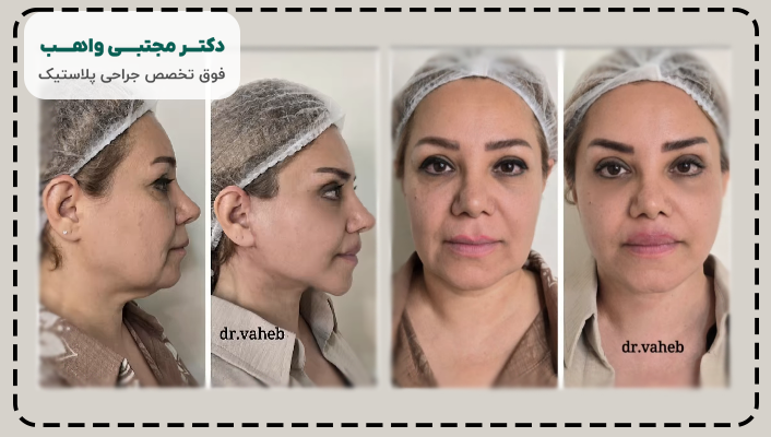 نمونه کار لیفت صورت دکتر واهب
