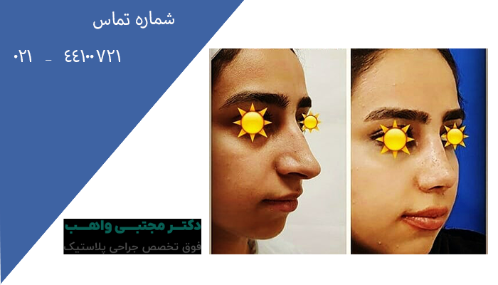 کاندیدای انجام جراحی بینی