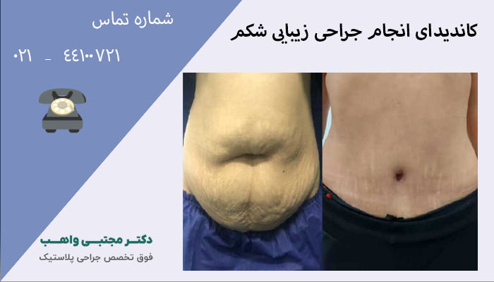 کاندیدای انجام جراحی زیبایی شکم
