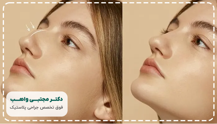 جراحی بینی استخوانی چیست