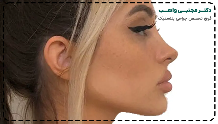 جراحی بینی فانتزی عروسکی