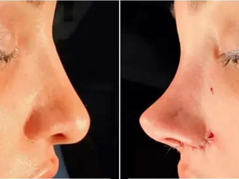جراحی بینی فانتزی
