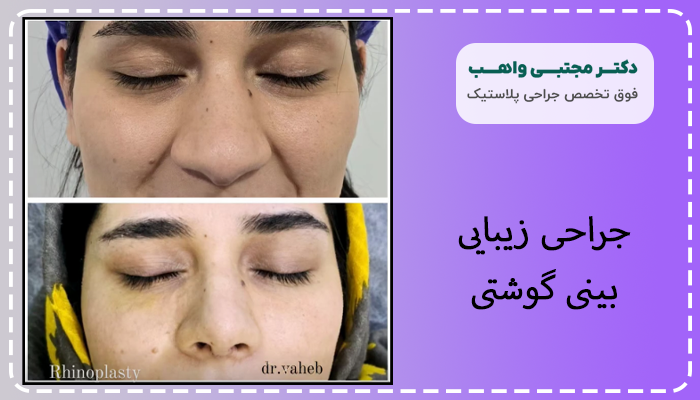 جراحی زیبایی بینی گوشتی