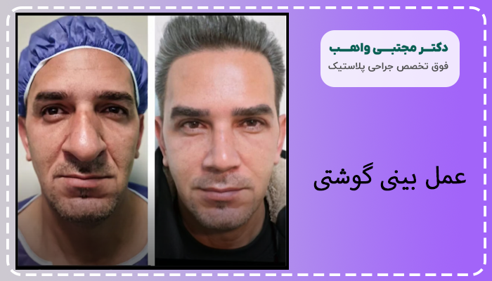 عمل بینی گوشتی