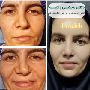 نمونه کار بهترین جراح بینی سعادت آباد دکتر واهب
