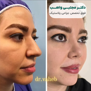 نمونه کار بهترین جراحی بینی سعادت آباد دکتر واهب