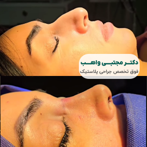 نمونه کار بهترین دکتر جراحی بینی سعادت آباد دکتر واهب
