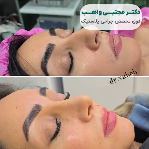 نمونه کار بهترین دکتر عمل بینی سعادت آباد دکتر واهب