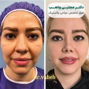 نمونه کار جراحی بینی دکتر واهب