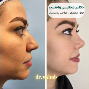 نمونه کار عمل بینی دکتر واهب