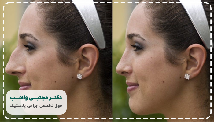کاندیدای جراحی بینی استخوانی