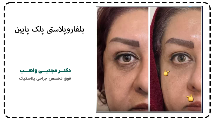 بلفاروپلاستی پلک پایین