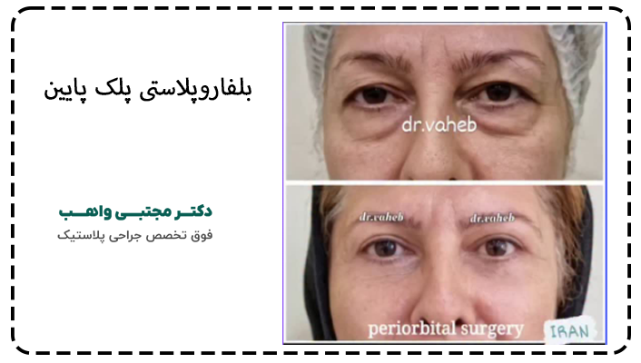 جراحی بلفاروپلاستی پلک پایین