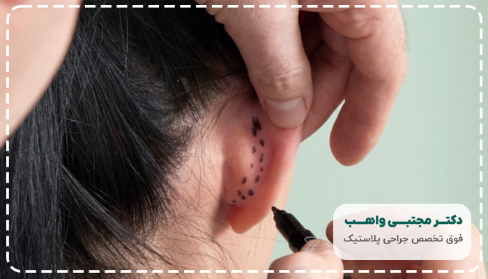 جراحی زیبایی گوش چیست