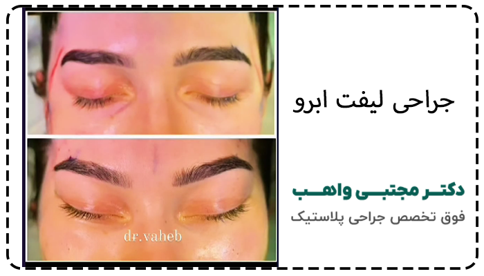 جراحی لیفت ابرو اندوسکوپیک