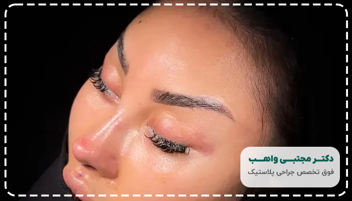 جراحی لیفت ابرو