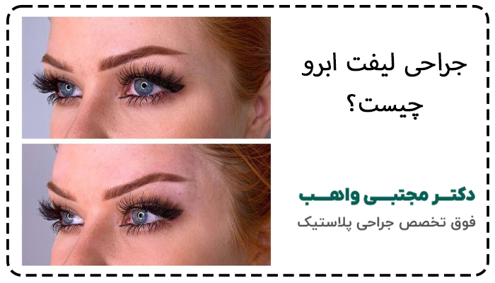 جراحی لیفت اندوسکوپیک ابرو و پیشانی