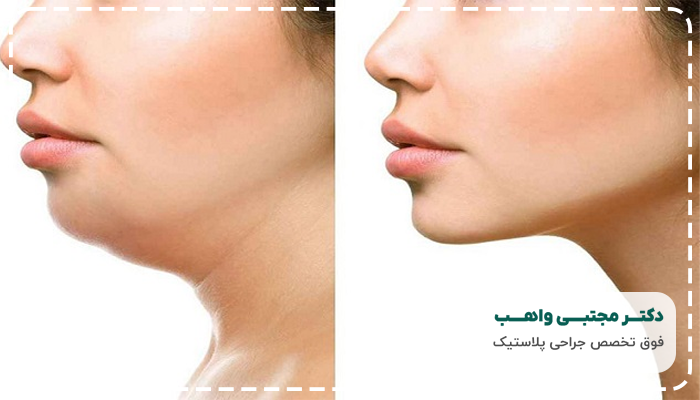 جراحی لیفت گردن چیست