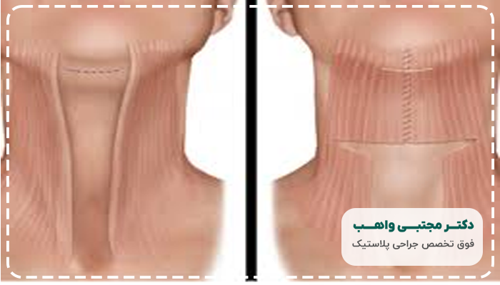 جراحی لیفت گردن
