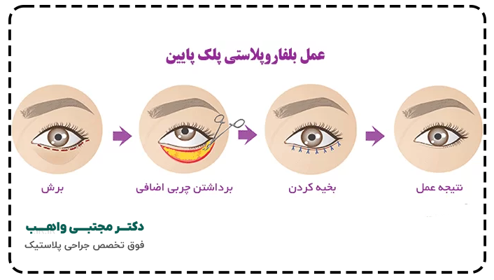 عمل جراحی بلفاروپلاستی پلک پایین