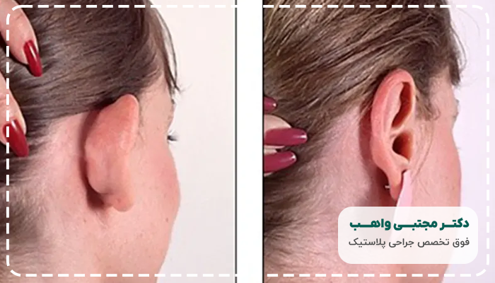 مزایای جراحی زیبایی گوش