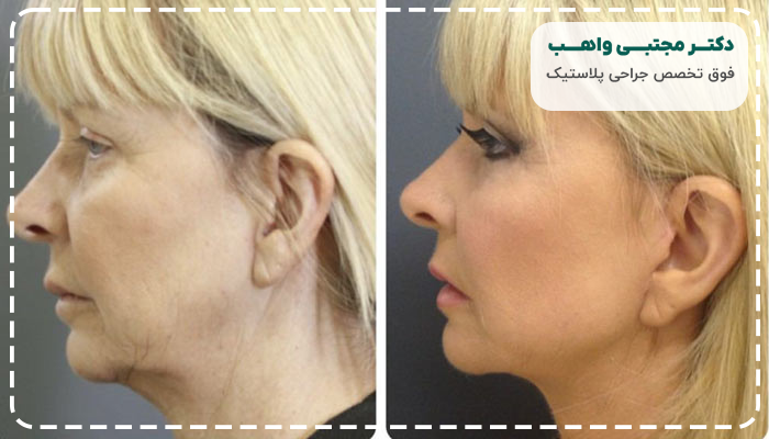 مزایای جراحی لیفت گردن