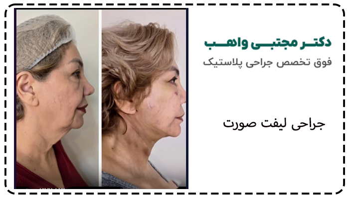 نمونه کار جراحی لیفت صورت