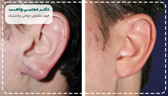 کاربرد جراحی زیبایی گوش