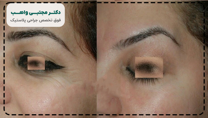 تفاوت لیفت ابرو و شقیقه