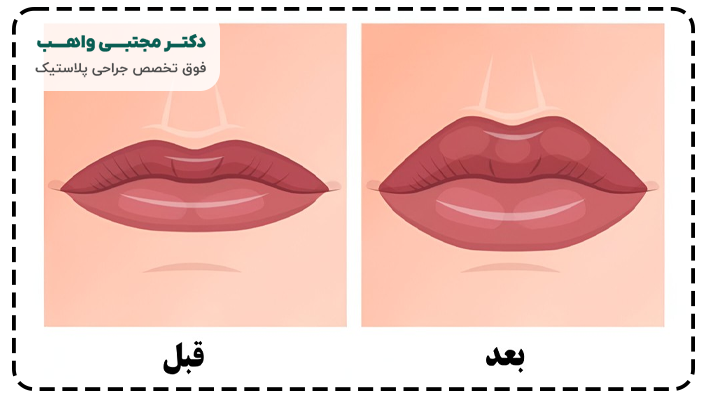جراحی زیبایی لب