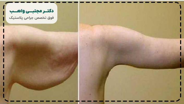 جراحی لیفت بازو