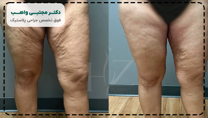 جراحی لیفت ران چیست