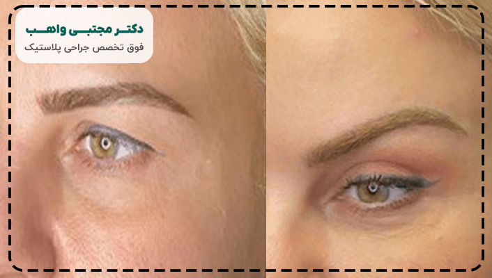 جراحی لیفت شقیقه چیست
