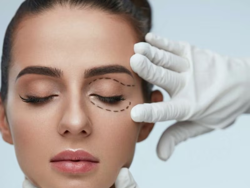 جراحی لیفت شقیقه