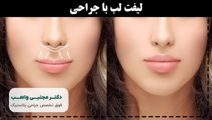 جراحی لیفت لب