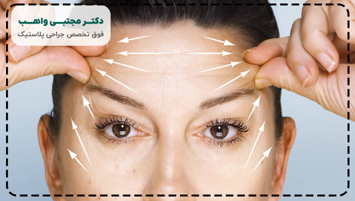 عمل لیفت شقیقه