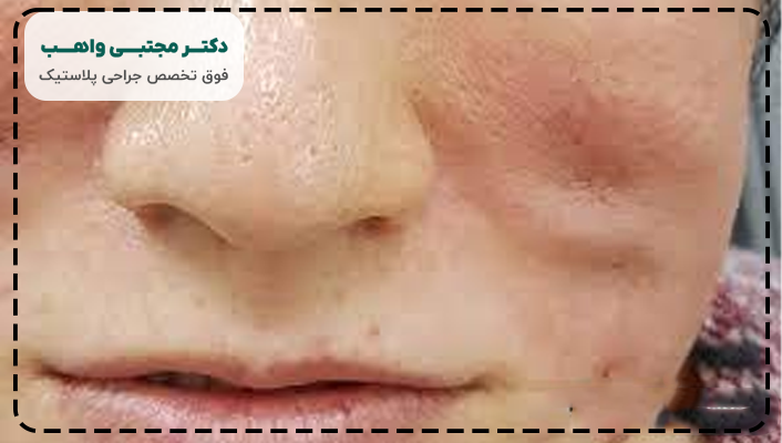 عوارض جراحی لیفت صورت