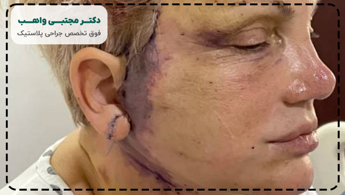عوارض طولانی مدت لیفت صورت