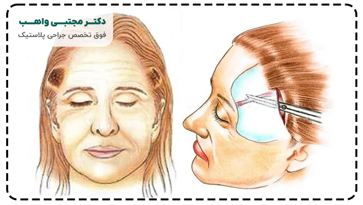 فرق بین لیفت ابرو و شقیقه