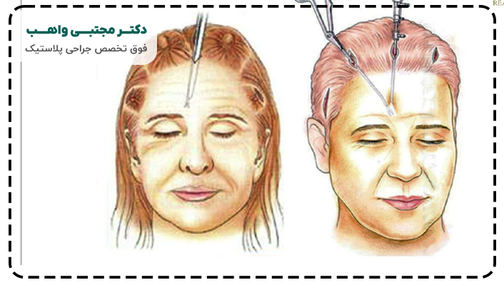 ماندگاری لیفت شقیقه اندوسکوپیک