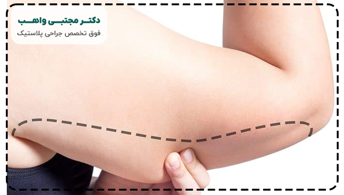 مزایای جراحی لیفت بازو