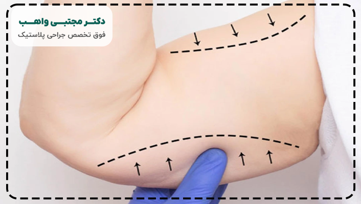 نحوه جراحی لیفت بازو