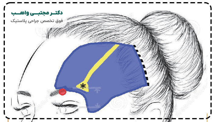 جلوگیری از ماندن جای بخیه