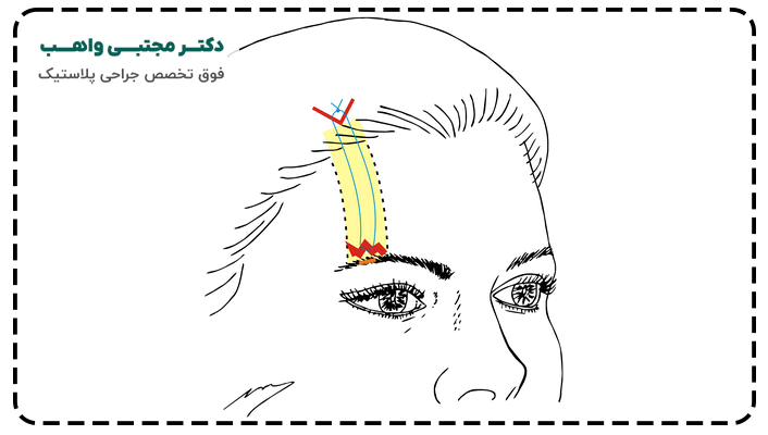 لیفت ابرو با بخیه زیر جلدی